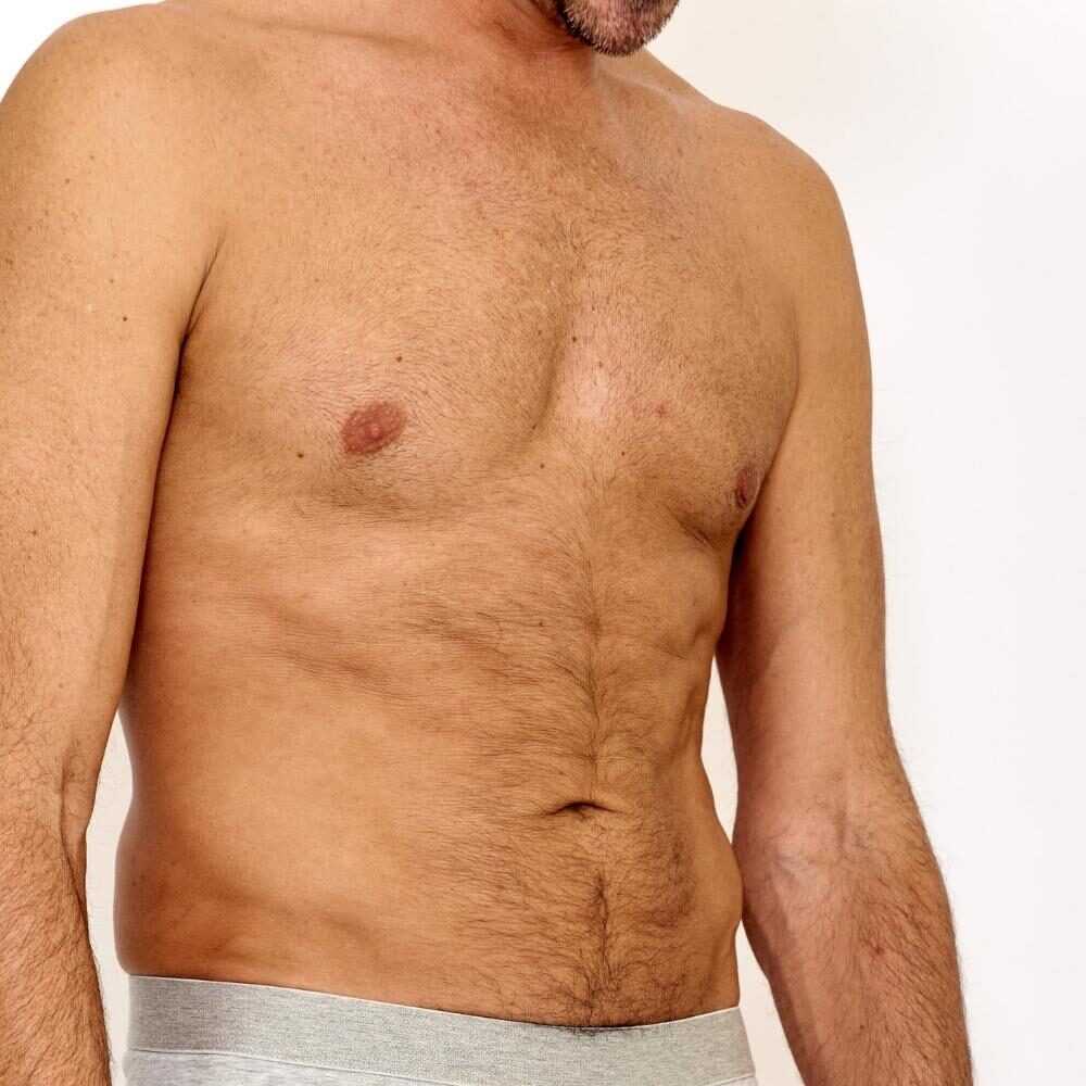 Gynaecomastia for Men