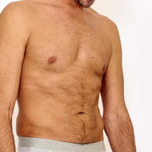 EA Clinic Harley Street offers gynaecomastia for men