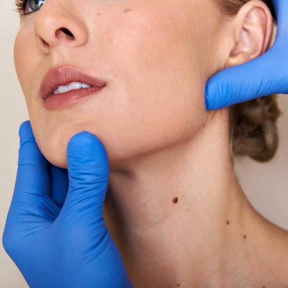 Vaser Lipo for Chin and Neck by Dr Edwin Anthony