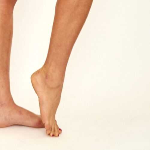 EA Clinic Harley Street Woman Poses for Bunions Treatment