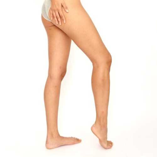 EA Clinic Harley Street Varicose Veins Treatment