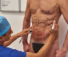 Vaser Hi Def, Soft Hi Def & Mid Def Lipo